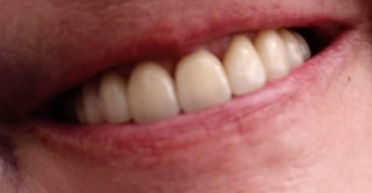 after smile treatment at Downtown Dental and Implantss of Oswego,Inc