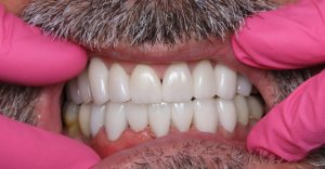 After teeth whitening treatment at Downtown Dental and Implants of Oswego,Inc