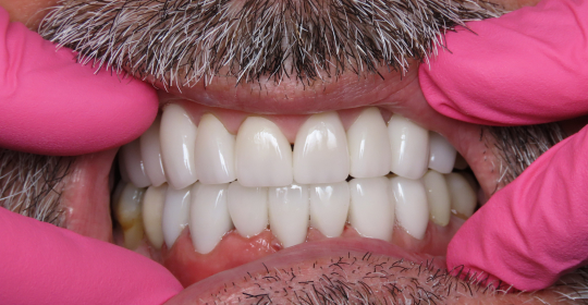 After smile treatment at Downtown Dental and Implantss of Oswego,Inc