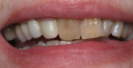 Before smile treatment at Downtown Dental and Implantss of Oswego,Inc