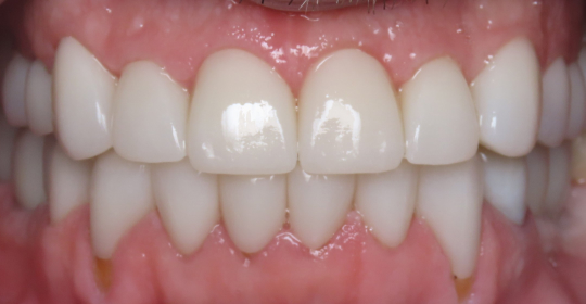 After-Mouth 2