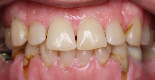 Before-Mouth 2